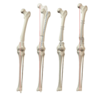 Reconstruction osseuse et allongement
